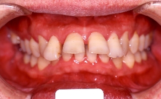 歯周病併発症例2
