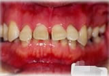 歯周病併発症例1