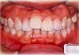 上顎前突(出っ歯)症例1