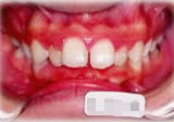 上顎前突(出っ歯)症例2